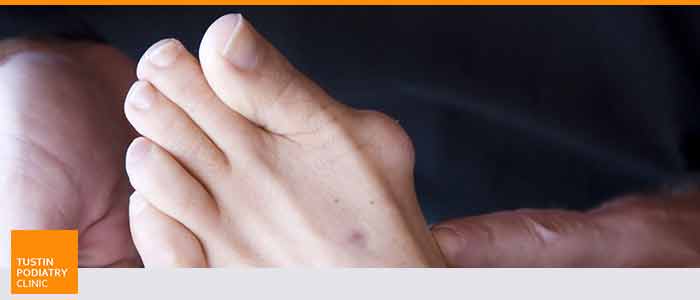 Bunion Treatment at Tustin Podiatry Clinic