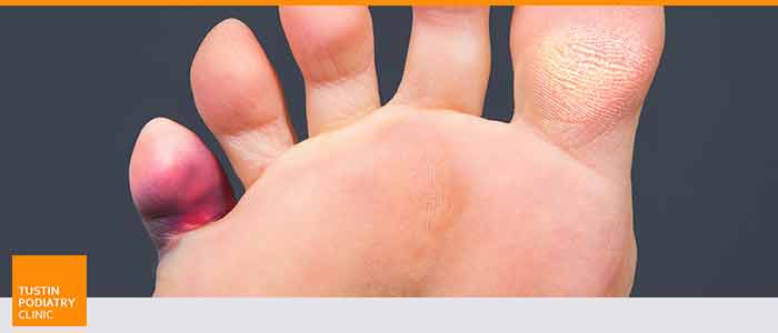 Ingrown Toenails: Causes, Symptoms, and Diagnosis