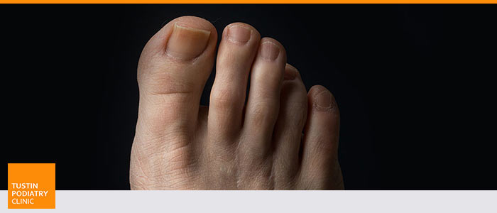 Morton’s Neuroma Treatment Clinic Near Me in Tustin CA