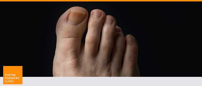 Morton’s Neuroma Treatment Clinic Near Me in Tustin CA