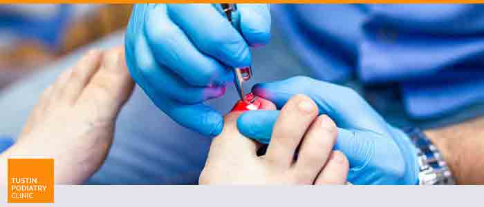 Laser Fungal Nail Treatment Near Me in Tustin CA