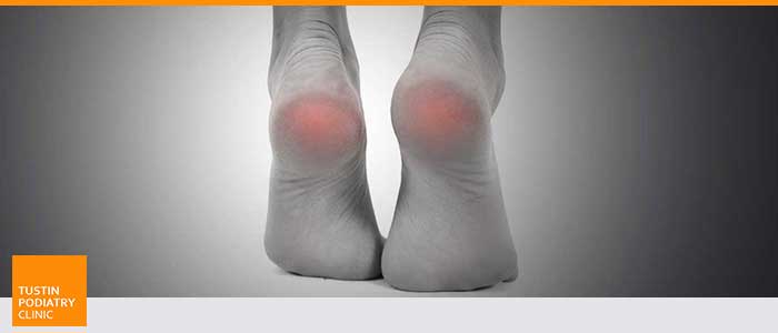 Heel Pain Treatment Specialist Near Me in Tustin, CA Heel Pain Treatment Specialist Near Me in Tustin, CA