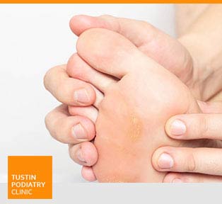 Calluses and Corns - Tustin Podiatry Clinic in Tustin, CA.