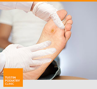 Foot Ulcer - Tustin Podiatry Clinic in Tustin, CA.