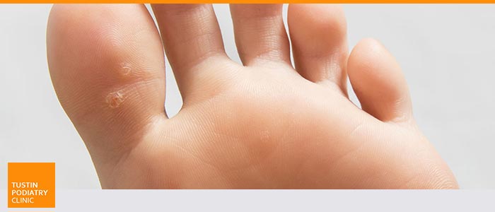 Foot Callus Removal: All You Need To Know - Northwich Foot Clinic