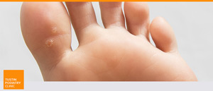 Foot Warts Treatment Near Me in Tustin CA