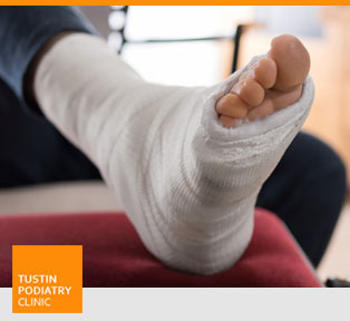 Fracture - Tustin Podiatry Clinic in Tustin, CA.