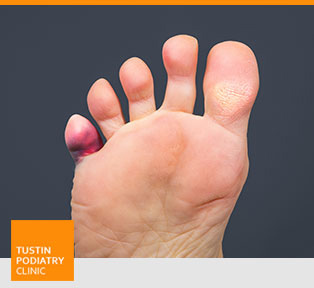 Hammertoe - Tustin Podiatry Clinic in Tustin, CA.