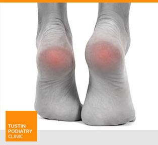 Heel Pain - Planter Fasciitis -  Tustin Podiatry Clinic in Tustin, CA.