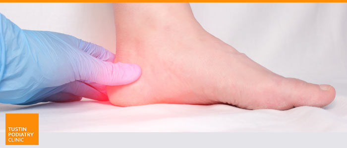 How to Treat Bone Spurs On the Top of Your Foot