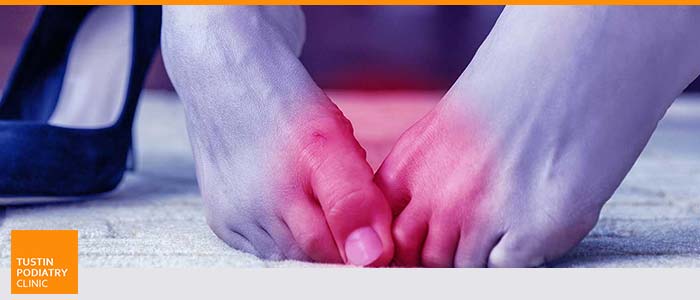 High-Arched Feet Treatment Near Me in Tustin CA High-Arched Feet Treatment Near Me in Tustin CA