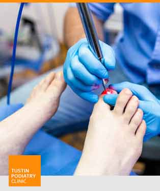 Laser Fungal Nail Treatment Near Me in Tustin, CA