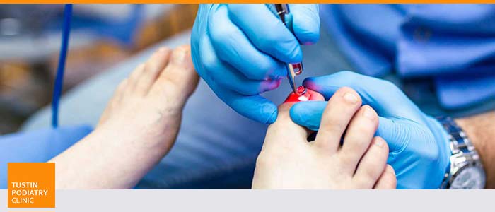 Laser Fungal Treatment Cost for Toenail Near Me in Tustin CA