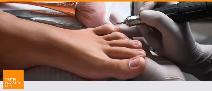 Foot Calluses : Your Questions Answered