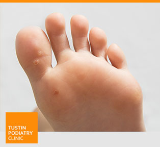 Warts - Tustin Podiatry Clinic in Tustin, CA.