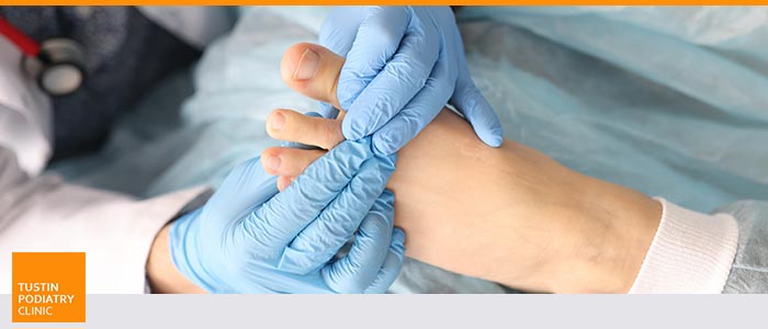 Ingrown Toenail Removal Specialist Near Me in Tustin CA