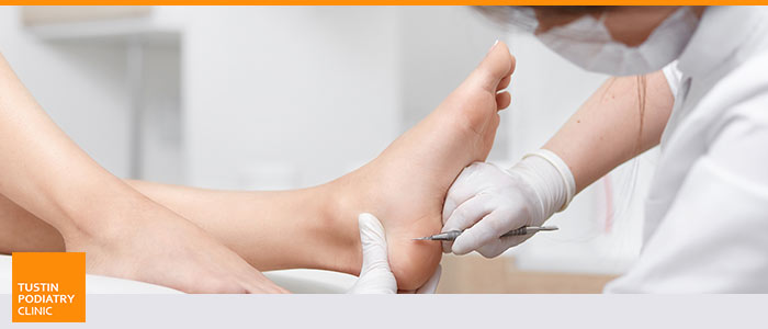 Callus Removal Treatment Near Me in Tustin CA