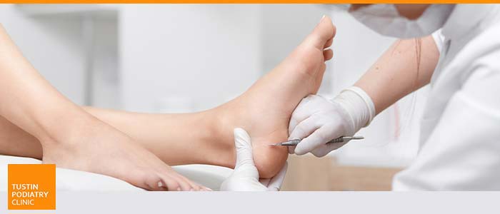 Calluses Specialist  Foot Callus Removal in Clifton and Wayne, NJ