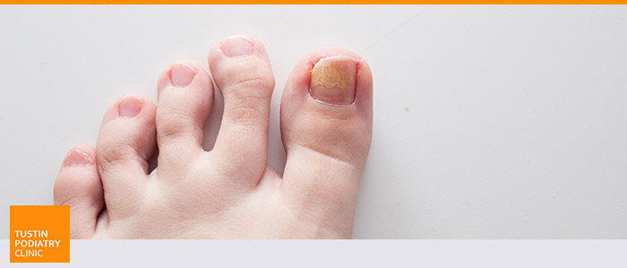 What to Do About Toenail Fungus - Suffolk Foot and Ankle