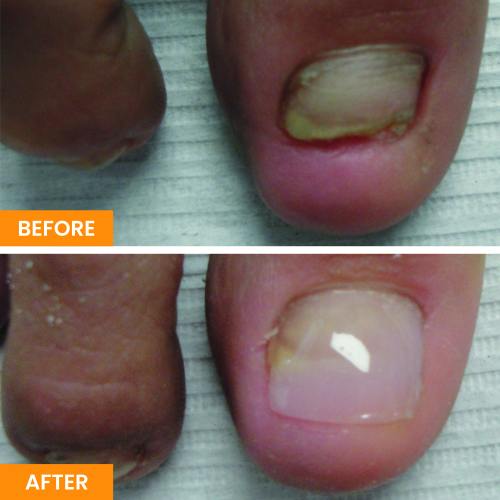 Nail Restoration Before and After in Tustin, CA Nail Restoration Before and After in Tustin, CA