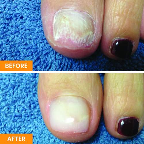 Nail Restoration Before and After in Tustin, CA Nail Restoration Before and After in Tustin, CA