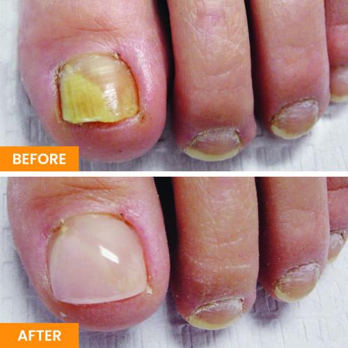 Before and After Nail Restoration Specialist in Tustin, CA Before and After Nail Restoration Specialist in Tustin, CA